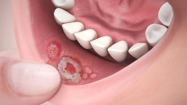 what causes Mouth Ulcers and sores in throat